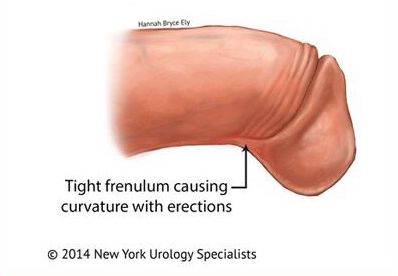 tight and short frenulum causing poor erections
